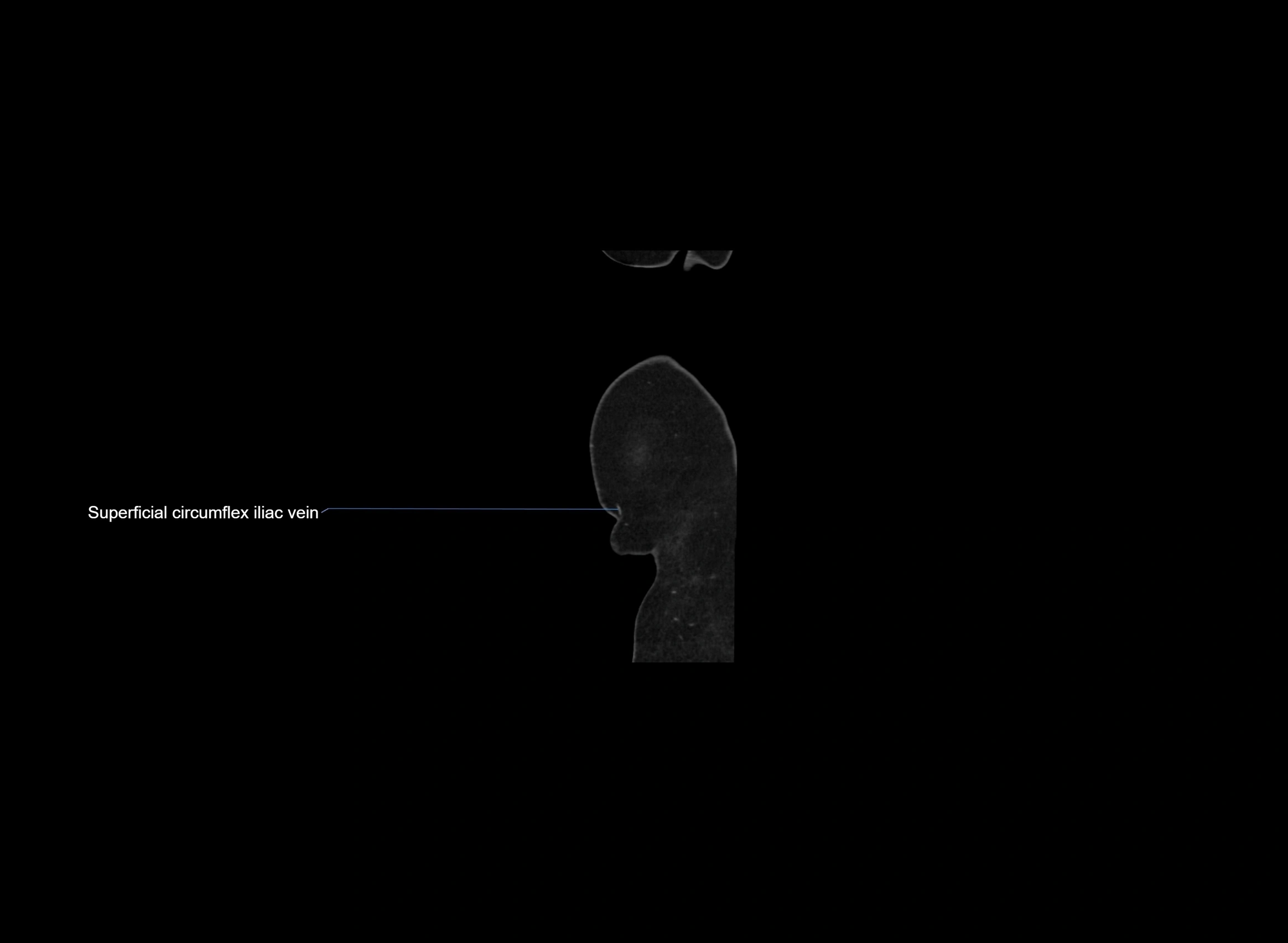 CT Abdomen sagittal cross sectional anatomy labelled radiology image -00001.webp